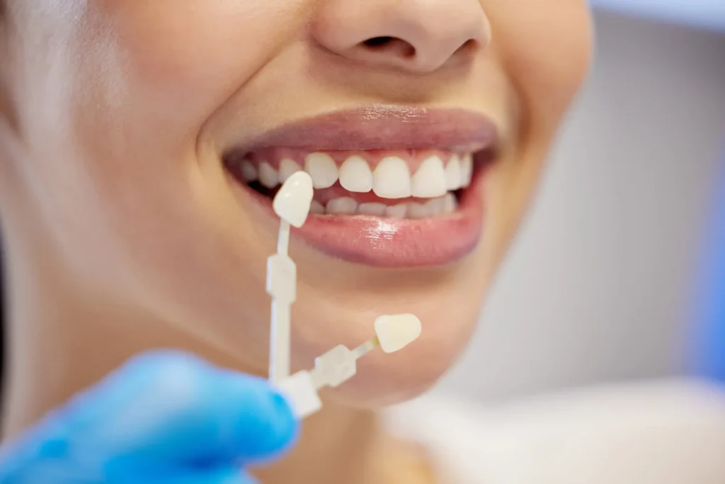 cosmetic dentist sunrise chooses a veneer shade