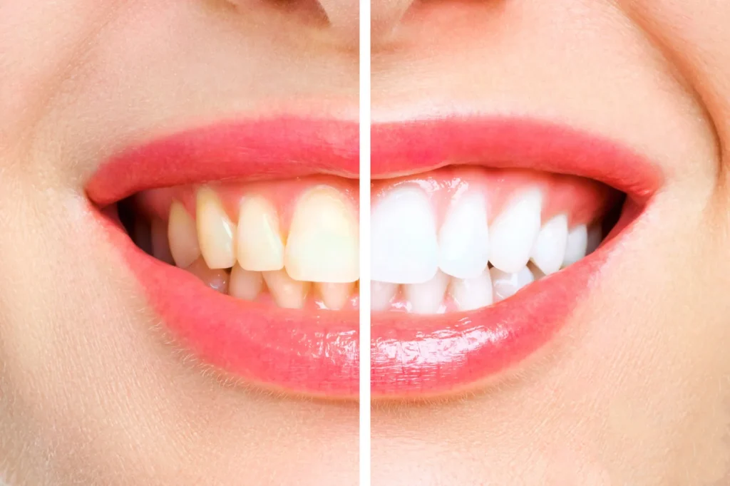 before and after cosmetic dentistry pembroke pines fl