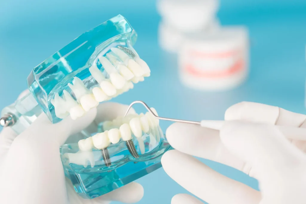 dental implants pembroke pines fl