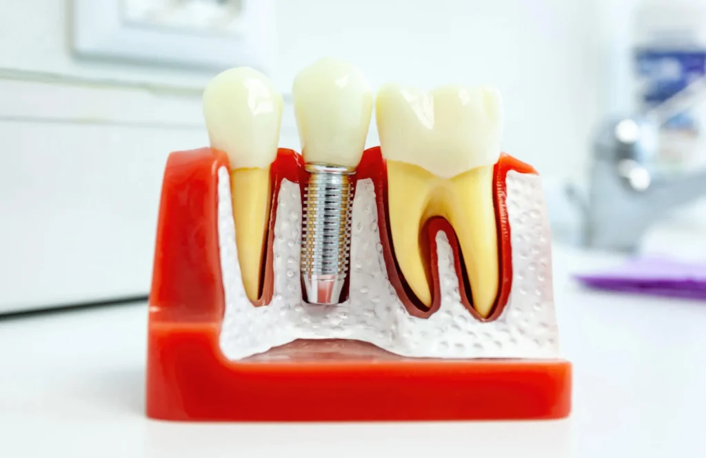dental implants pembroke pines fl design