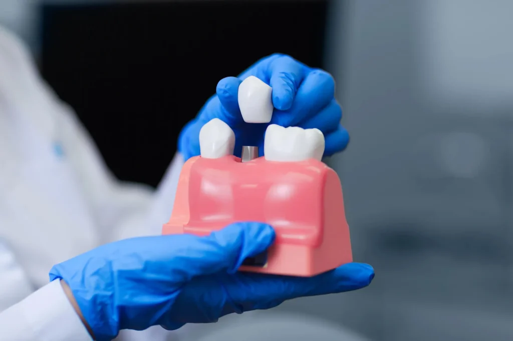 dental implants pembroke pines fl model