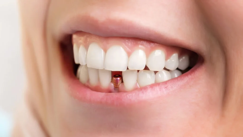 patient with dental implants pembroke pines fl
