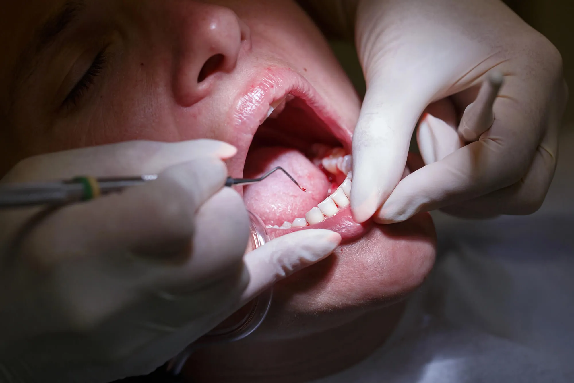 dentist-sunrise-fl-cleaning-patient's-teeth