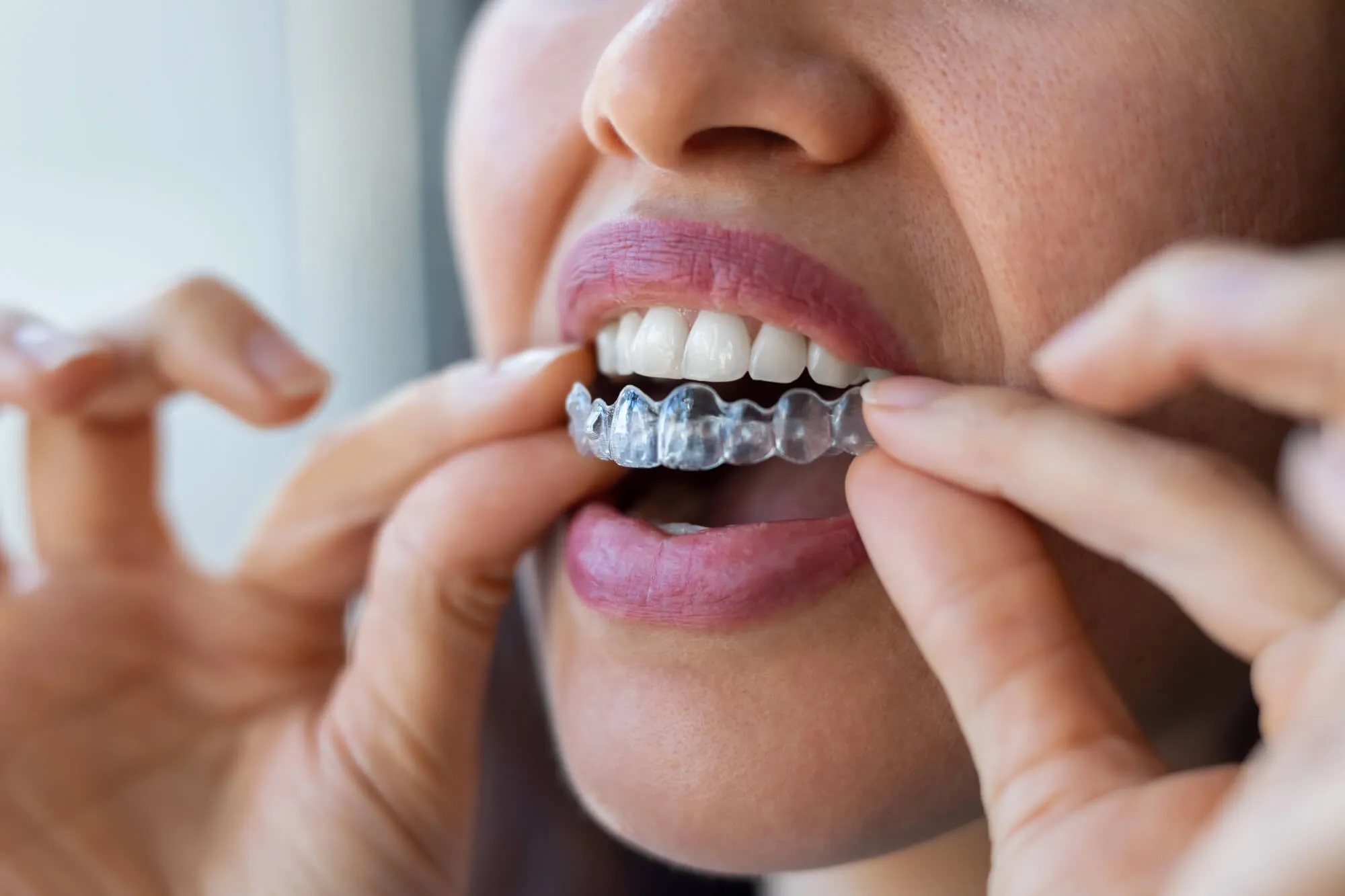 woman following the instructions of her orthodontist pembroke pines fl