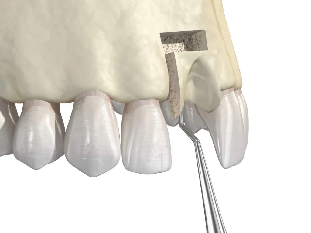 oral surgeon pembroke pines bone graft