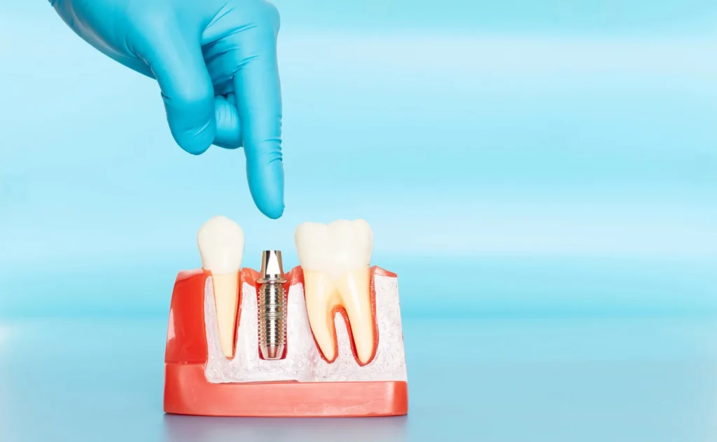 oral surgeon pembroke pines shows patient an implant model