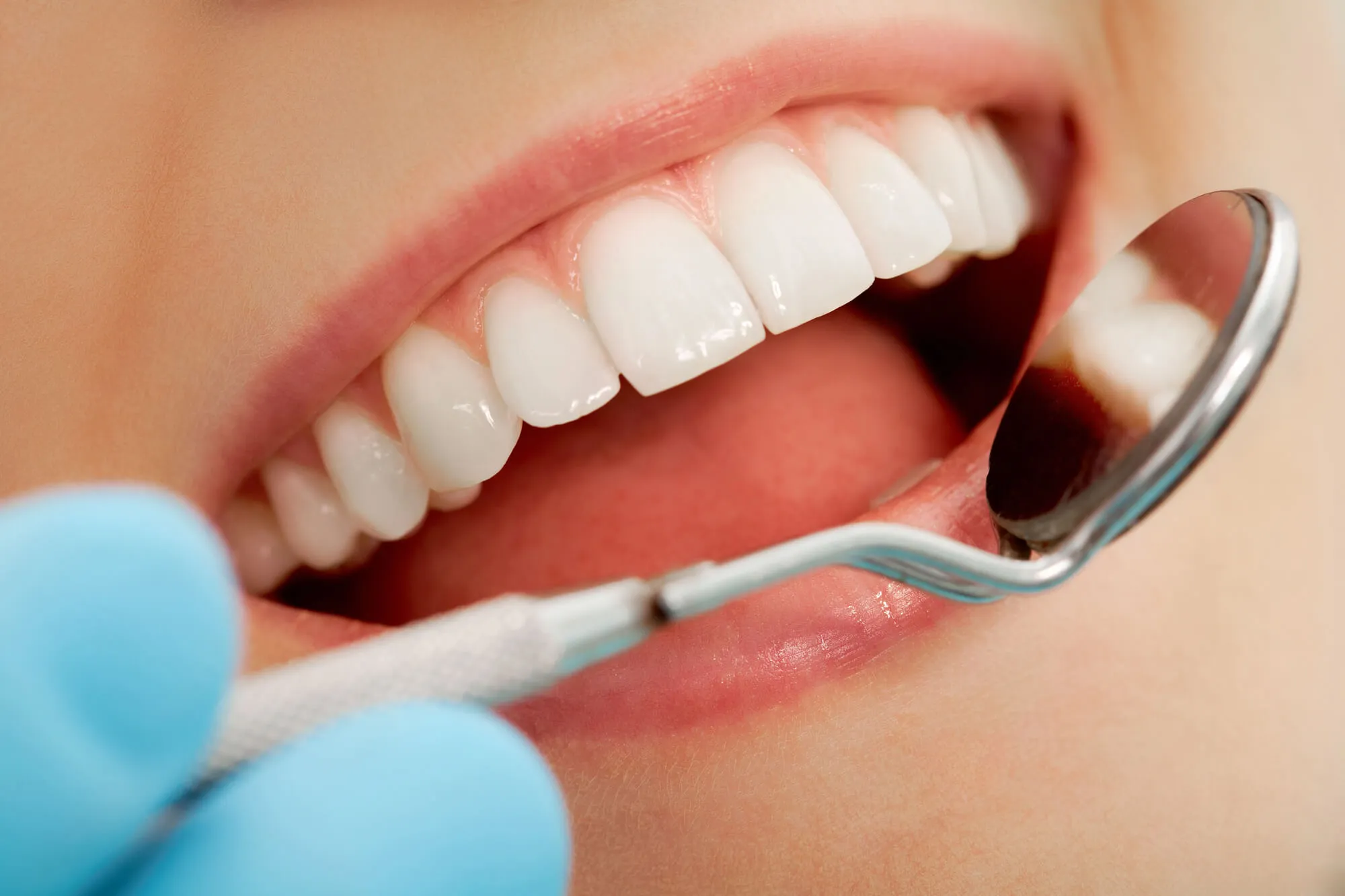 before teeth whitening sunrise