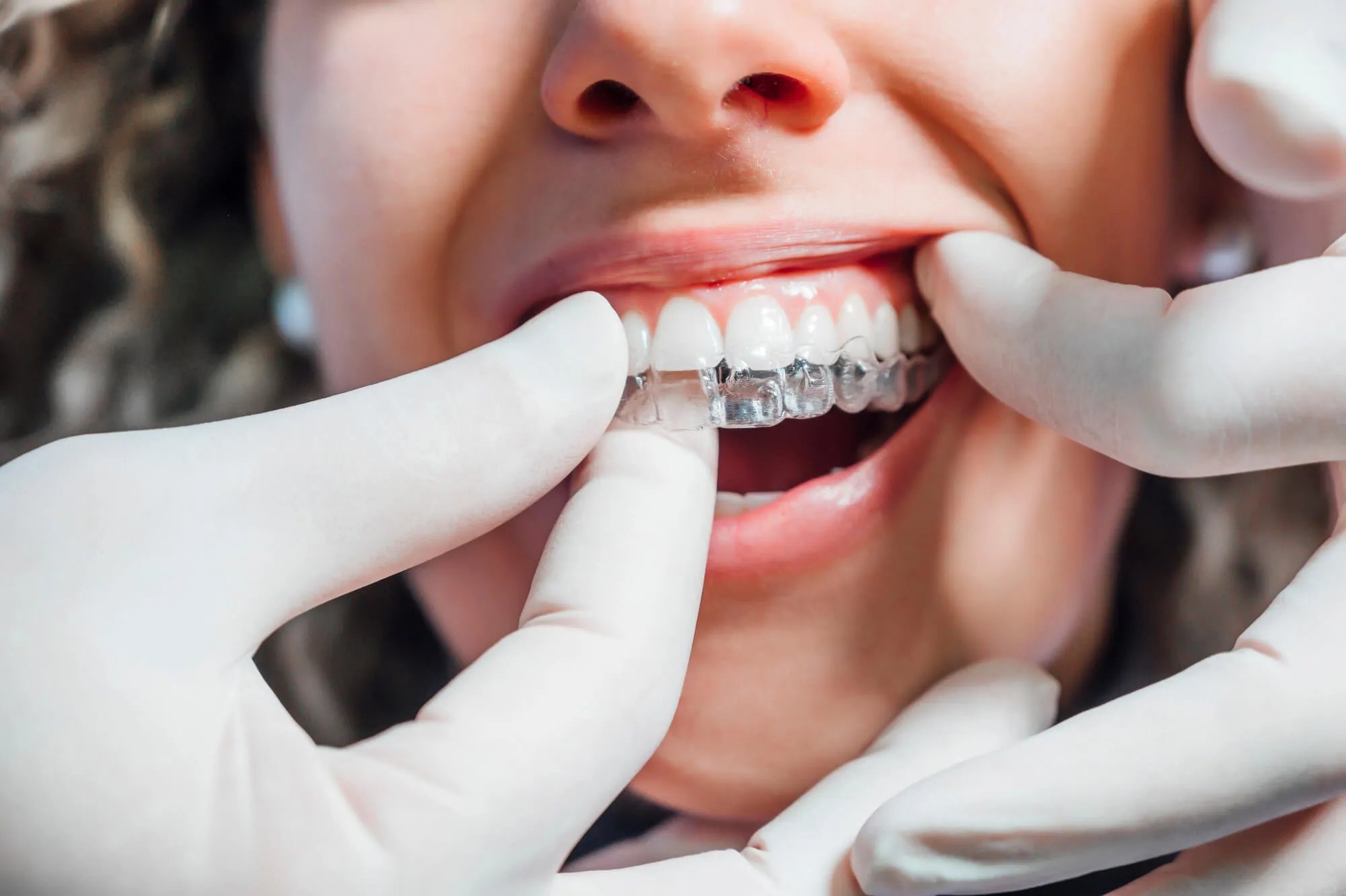 putting on invisalign pembroke pines