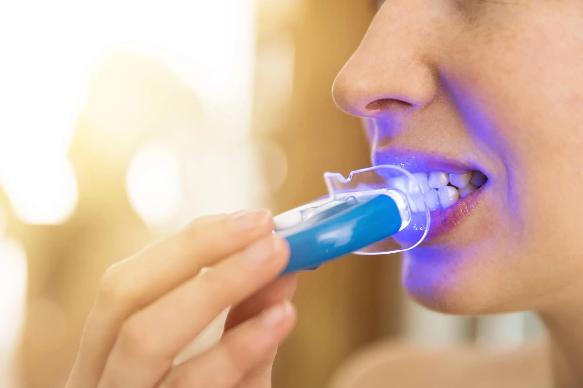 teeth whitening sunrise home kit