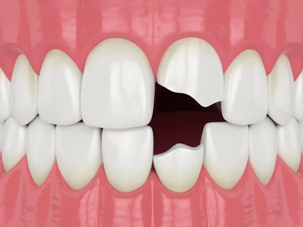 broken-tooth-needs-an-emergency-dentist-miramar